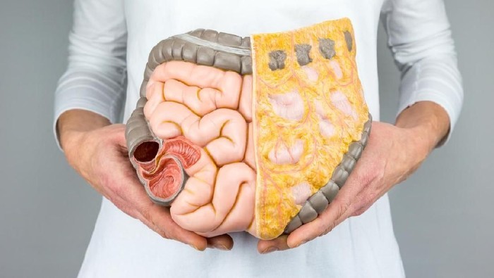 Kok Bisa Usia 20-an Sudah Kena Kanker Usus Besar? Dokter Bilang Gini