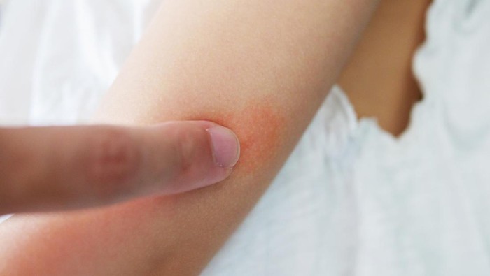 9 Cara Menghilangkan Biduran dengan Cepat Secara Alami dan Tanpa Obat 